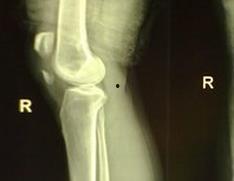 髌骨骨折可以吃哈密瓜吗,哈密瓜的适宜摄入与注意事项